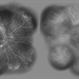 Cystoid Macular Edema (CME) Cystoid Macular Edema (CME)